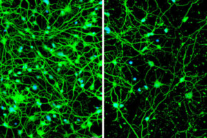 Cellular housekeeping process implicated in fatal neurological disorder