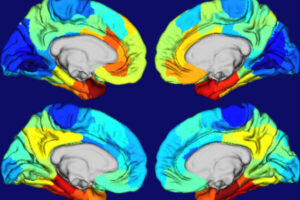 Study yields clues to why Alzheimer’s disease damages certain parts of the brain