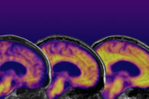 Podcast: Newly approved drug may slow progression of Alzheimer’s