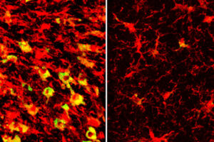 Lowering a form of brain cholesterol reduces Alzheimer’s-like damage in mice