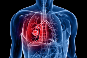 Liquid biopsy could guide treatment decisions for oligometastatic lung cancer